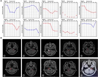 Sudden sensorineural hearing loss as the initial symptom in patients with acoustic neuroma